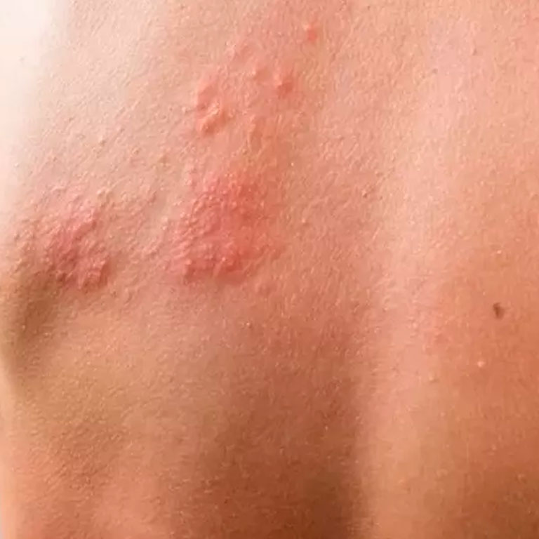 Herpes Z Ster Causas Sintomas Complica Es E Tratamento