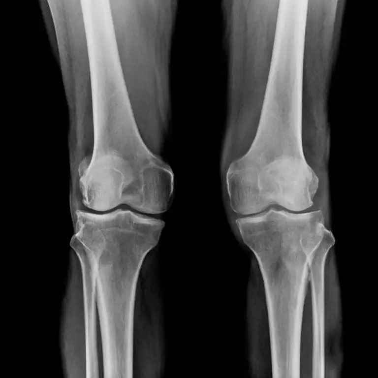Osteoporose: O que é, causas, prevenção e tratamento